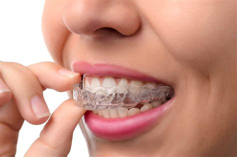 Tips For Living With Invisalign Clear Aligners | Bailey Orthodontics