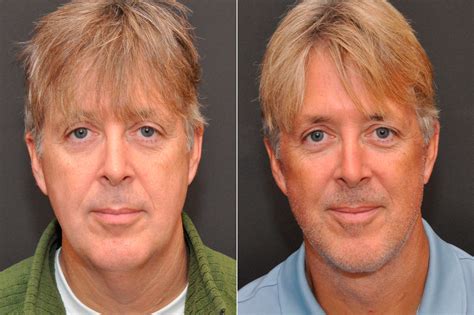 Celebrity Male Plastic Surgery Before And After Photos - Bank2home.com