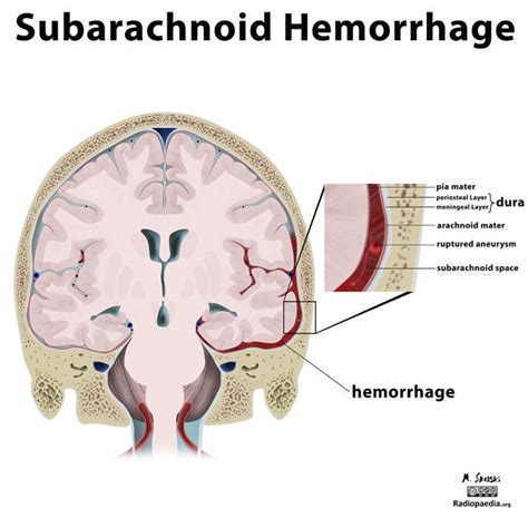 Subarachnoid hemorrhage pathophysiology - wikidoc