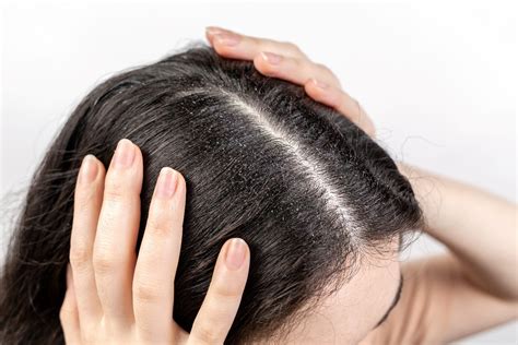 Dandruff vs Dry Scalp: What’s the Difference? | H&S India