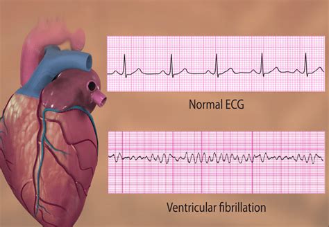 Ventricular Fibrillation: Causes, Treatment, Nursing Management