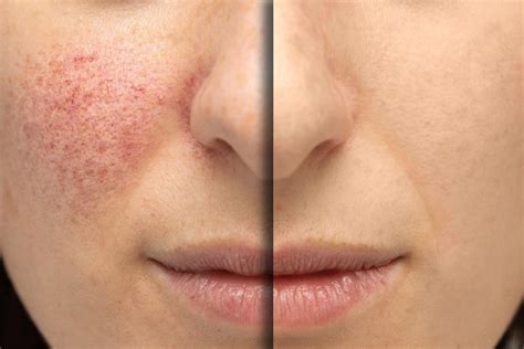 Rosacea Treatment (IPL) – Laserlife Clinic London