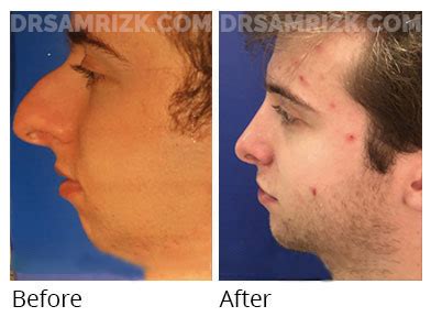 Chin Implant Patient Gallery | Chin Implant Surgery in New York