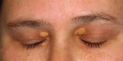 Eyelid Xanthelasma Removal In Riyadh & Saudi Arabia | Clinic