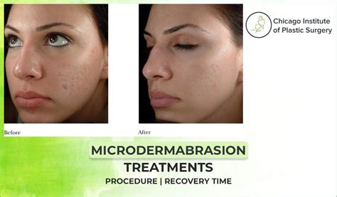 Microdermabrasion Treatments: Procedure | Cost | Recovery Time| Uses ...