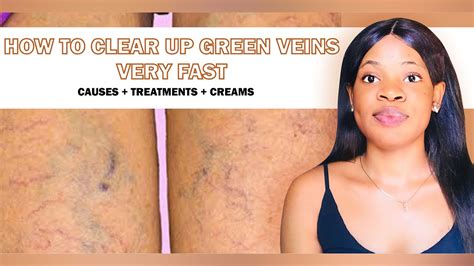 HOW TO CLEAR UP GREEN VEINS VERY FAST: Causes & Treatments + Best ...