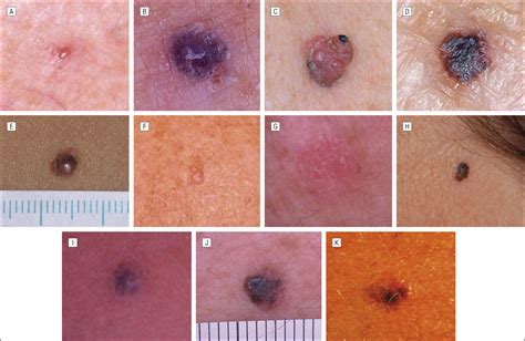 Nodular Melanoma Dermoscopy