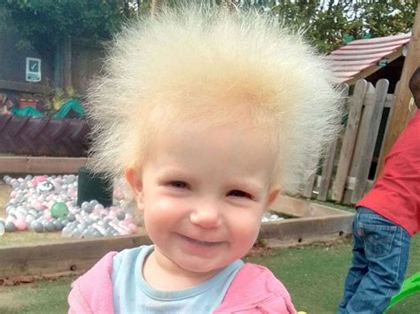 Toddler With Wild Hair Diagnosed With Rare Syndrome - Newsweek