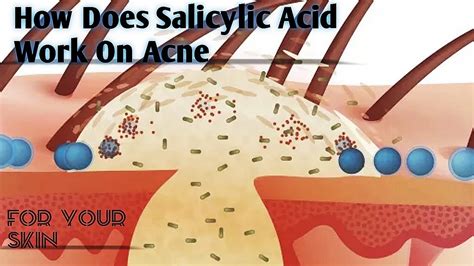 || How Does Salicylic Acid Work On Acne And Pimples | Animation | For your SKIN || - YouTube