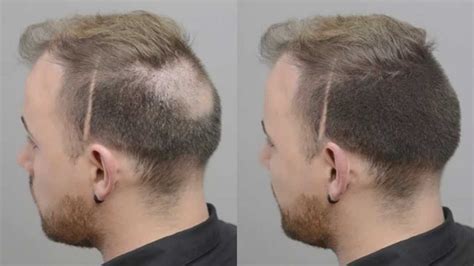 How To Cover Up A Receding Hairline Tips And Tricks In 2023 - Semi ...