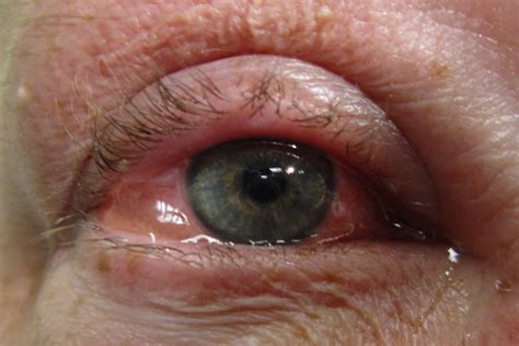 Conjunctivitis, causes and symptoms | Emergency Live