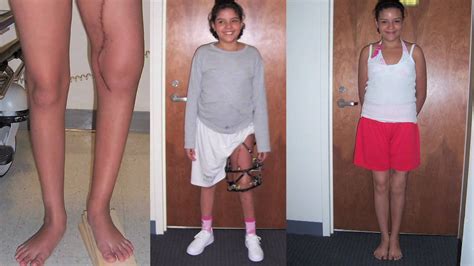 limb shortening surgery costume