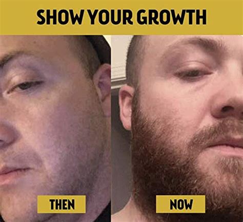 B0798817L1 Advanced Beard Growth Kit | The Beard Club | Growth Vitamins ...