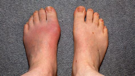 Novel Gout Drug Passes Mid-Stage Test | MedPage Today