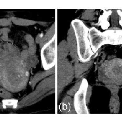 Imaging results of MRI in case 2. (a) A mass with non-uniform high... | Download Scientific Diagram