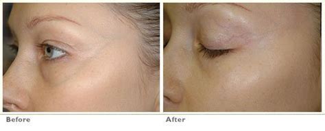 Sclerotherapy Under Eye Vein Removal - Blue Veins Under Eye