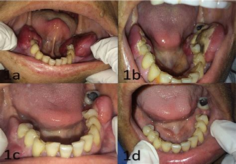 Figure 1 from Large Extramedullary Plasmacytoma in Oral Cavity in a patient with Lympho ...