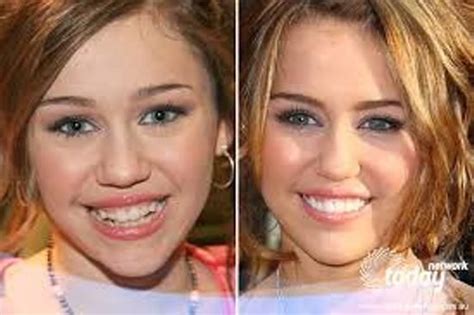 Miley Cyrus Braces And Teeth Transformation | Celebrity teeth, Nose job ...