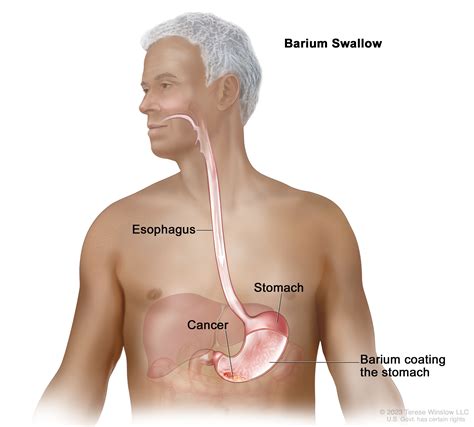 Gastric Cancer | Vanderbilt-Ingram Cancer Center