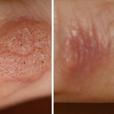 How To Keep Warts From Coming Back - Theatrecouple12