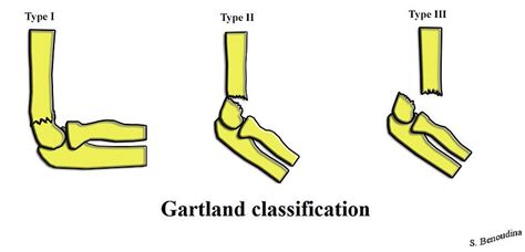 800px-Gartland_Classification - Don't Forget the Bubbles