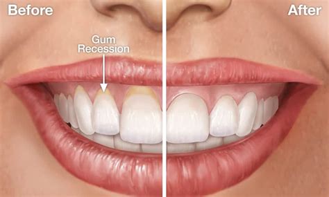 Gum Recession Symptoms And Treatment - Smile Team Turkey