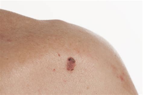 Understanding Squamous Cell Carcinoma - Pennsylvania Dermatology Specialists
