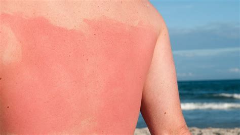 Man's Sunburn Is Going Viral, Reminds Us the Importance of Sunscreen ...