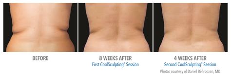 Coolsculpting | Rhett Women's Center | Make Your Health A Priority