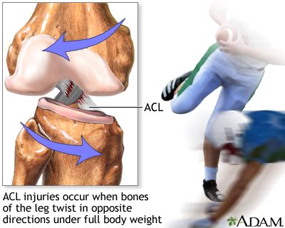 What is an acl tear - reterdoctor