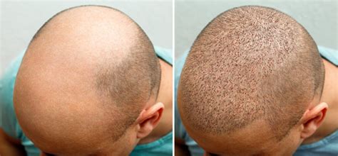 FUE Hair Transplant Before and After Process