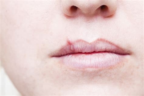 What Does A Cold Sore On Lip Look Like | Sitelip.org