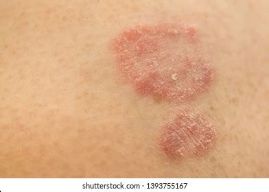 Black Mole On Skin Stock Photo 379974037 | Shutterstock