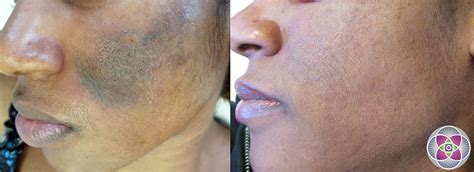 Laser Treatments For Hyperpigmentation: The Dark Side | Justinboey