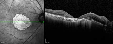 Geographic atrophy - Retina Image Bank