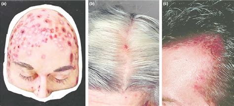 Acne necrotica definition, causes, symptoms, diagnosis & treatment