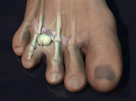 Neuroma | Morton’s Neuroma | Causes of Neuroma | Neuroma Treatment IN RICHARDSON, DALLAS ...