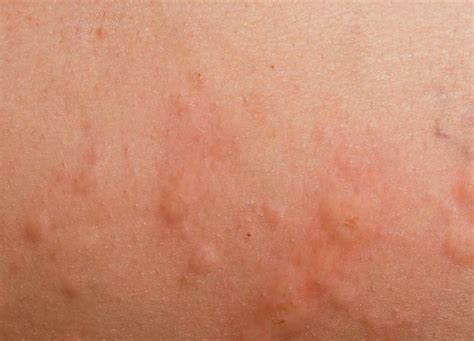 Chlorine Rash - Pictures, Symptoms, Causes, Treatment