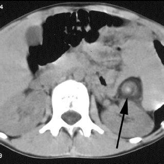 (PDF) Biliary Atresia