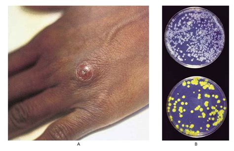 mycobacterial infection - pictures, photos