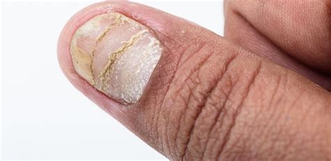 7 common myths about psoriasis | Ageless Online