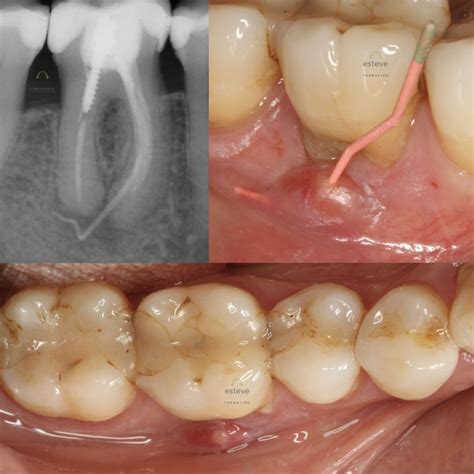 Endo-Resto molar inferior con fístula - Formación Clínica Dental Esteve