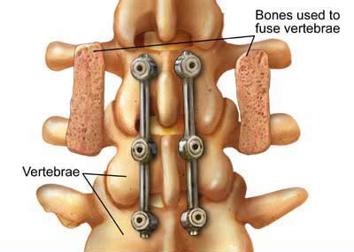 Post-Laminectomy Syndrome Treatment in New York City