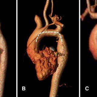 Morphological variations of the aortic arch in patients following... | Download Scientific Diagram