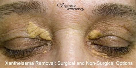 Xanthelasma Removal: Surgical and Non-Surgical Options - Siperstein Dermatology Group