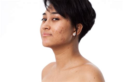 How to Get Rid of Dark Spots on the Face Quickly - Tonique Skincare