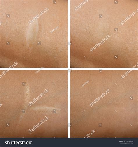 145 Scar Removal Surgery Before After Images, Stock Photos, 3D objects, & Vectors | Shutterstock