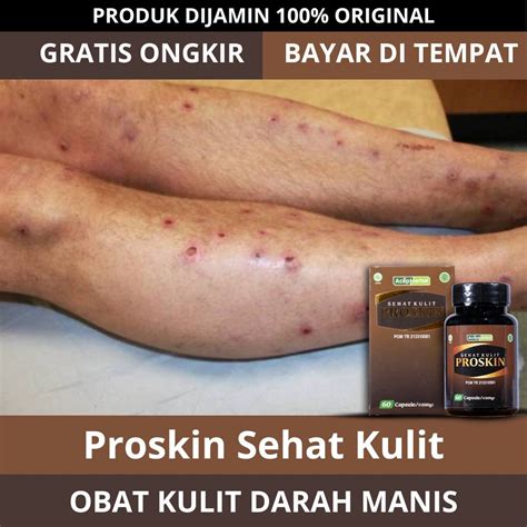 Jual Obat Darah Manis - Obat Penyakit Darah Manis Prurigo Di Kaki Untuk Anak Dan Dewasa ...