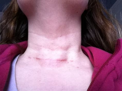 My Thyroidectomy: A Personal Account: Scar - 4 weeks post thyroidectomy