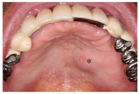 Applied Sciences | Free Full-Text | Late Developed Unusual Nasal ...